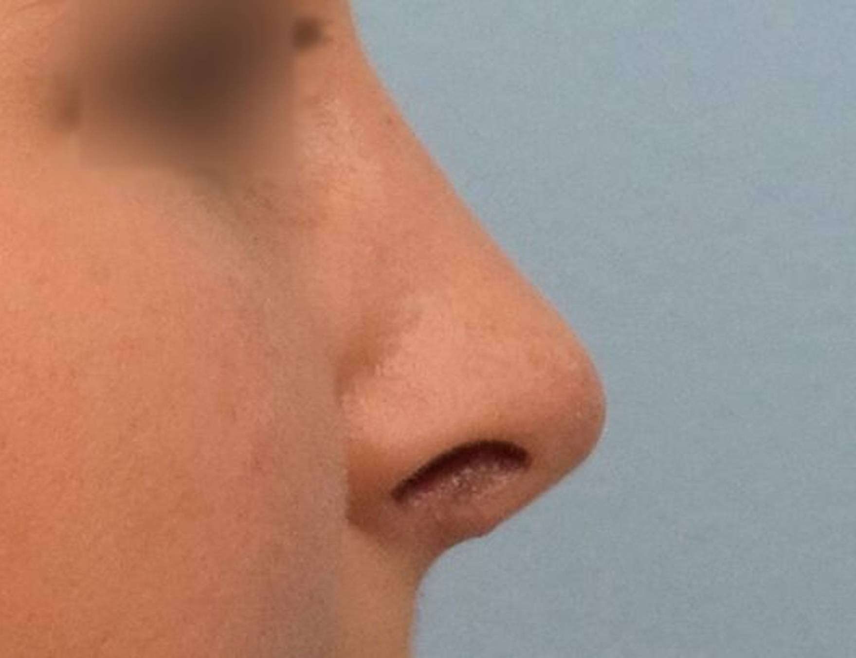 Rhinoplasty Before & After Image