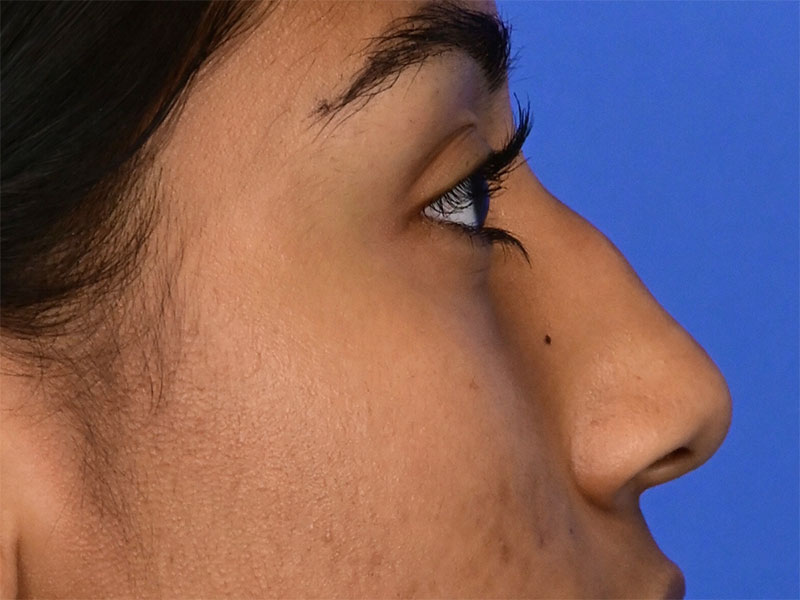 Rhinoplasty Before & After Image