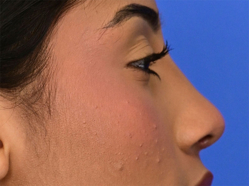 Rhinoplasty Before & After Image