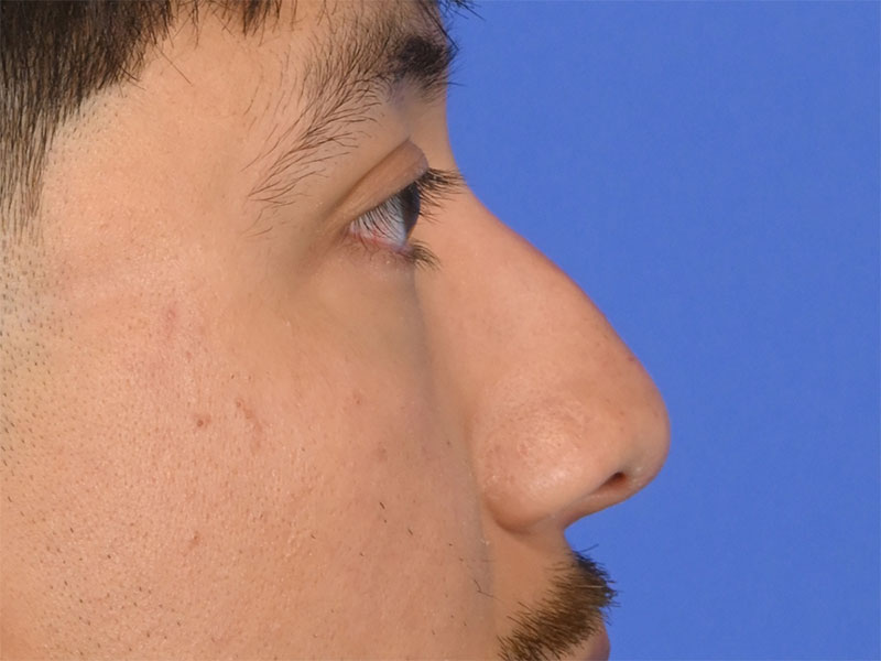 Rhinoplasty Before & After Image