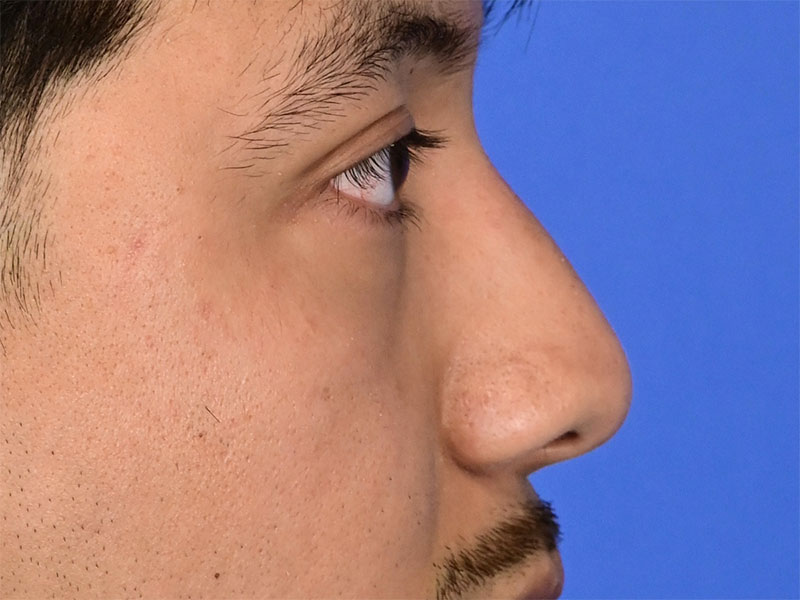 Rhinoplasty Before & After Image