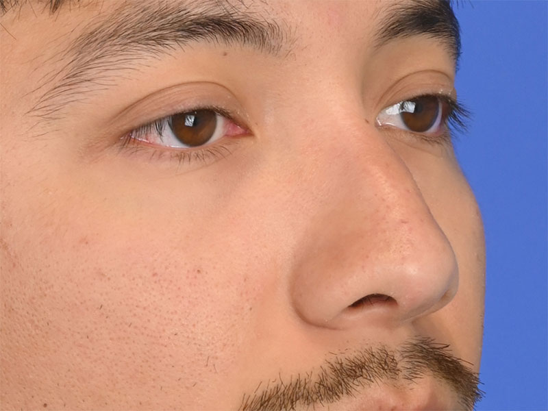 Rhinoplasty Before & After Image