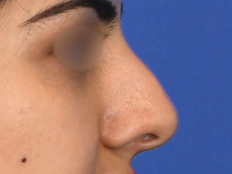 Rhinoplasty Before & After Image