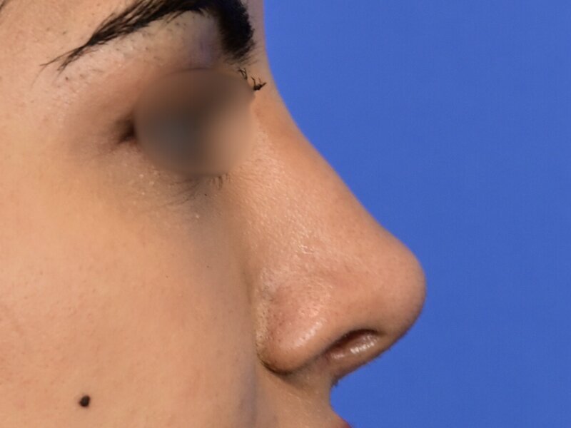 Rhinoplasty Before & After Image