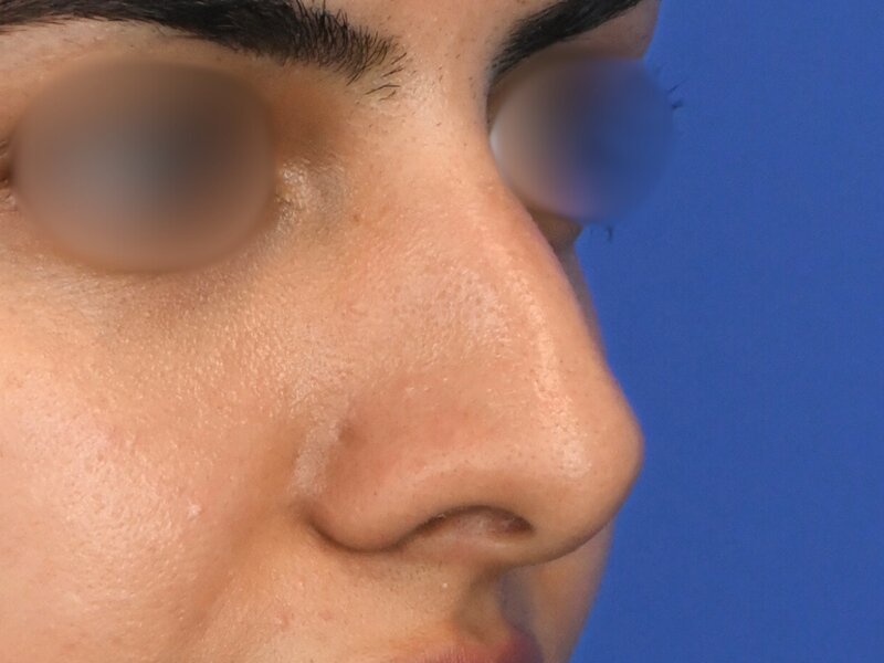 Rhinoplasty Before & After Image