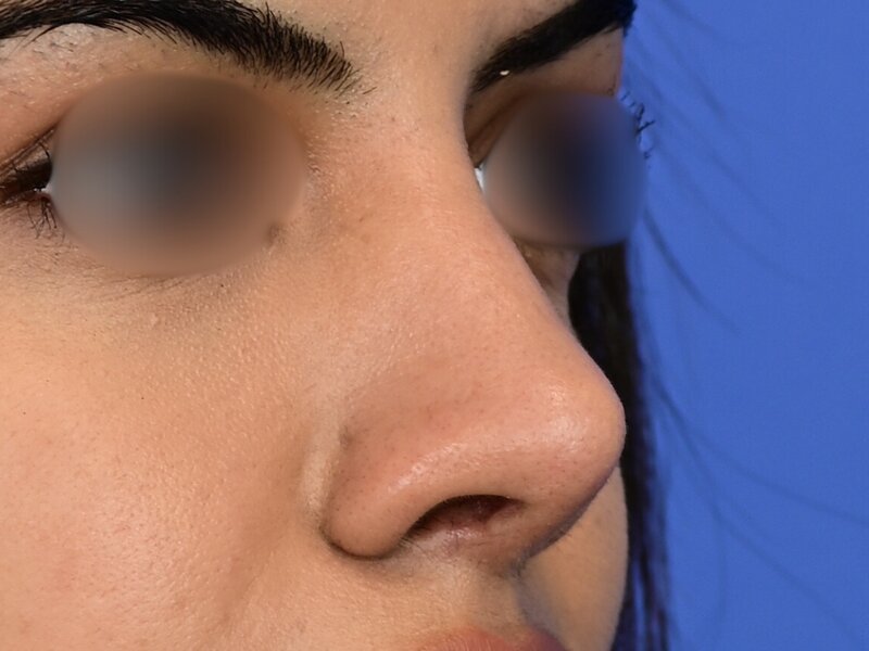 Rhinoplasty Before & After Image