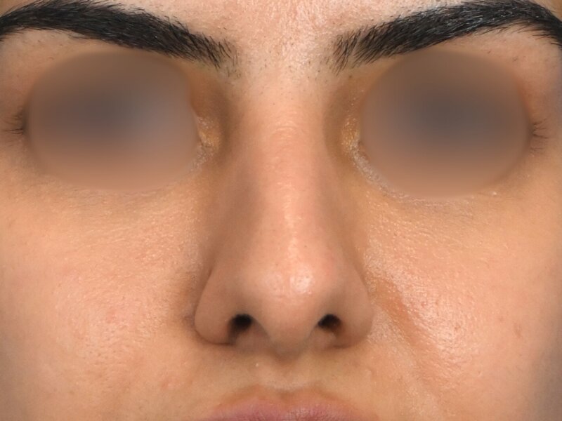 Rhinoplasty Before & After Image