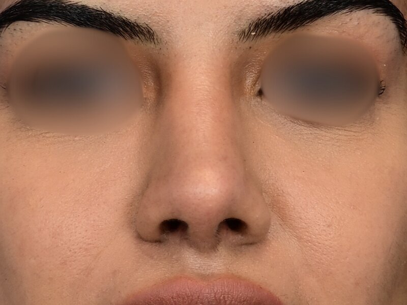 Rhinoplasty Before & After Image